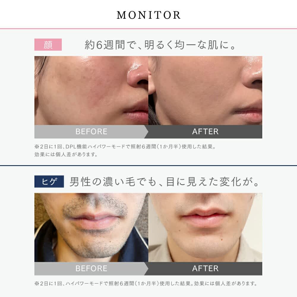 MYTREX MiRAY1回のみ使用 レンタル] MYTREX(マイトレックス) MiRAY ONE マルチヘッド美顔