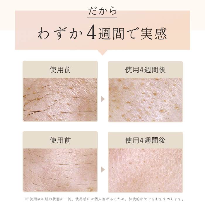レンタル】ステラボーテ(STELLA BEAUTE)・IPL光美容器 Luna