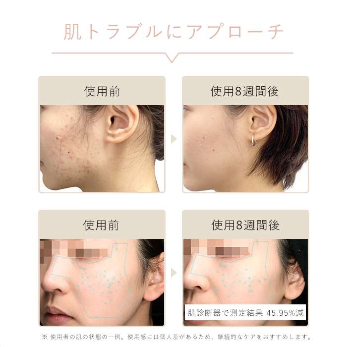 レンタル】ステラボーテ(STELLA BEAUTE)・IPL光美容器 Luna
